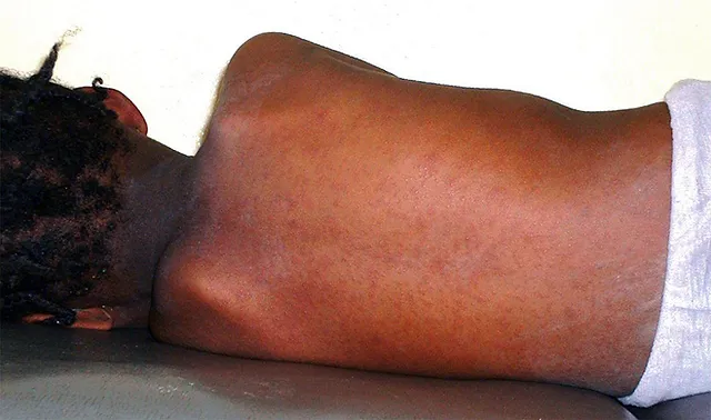  Gitega fait la sourde oreille face à la rougeole  qui ravage le nord du pays 