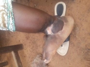 L’ulcère de Buruli fait rage à Butihinda